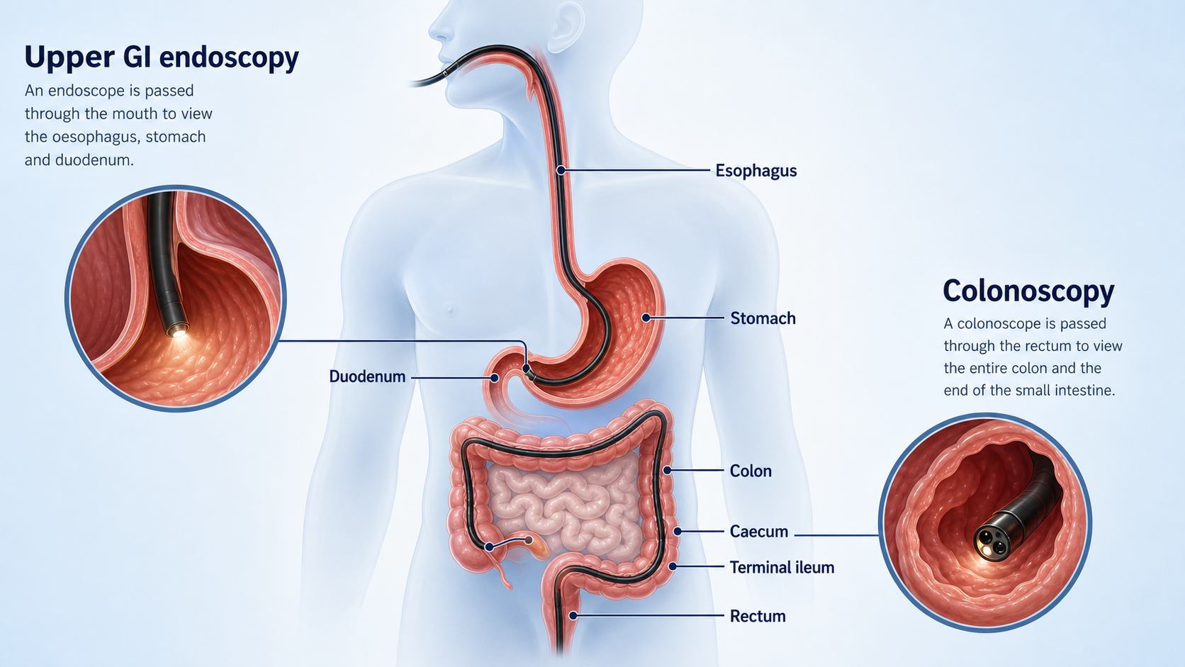 Endoscopy image panel used to illustrate upper-GI diagnosis