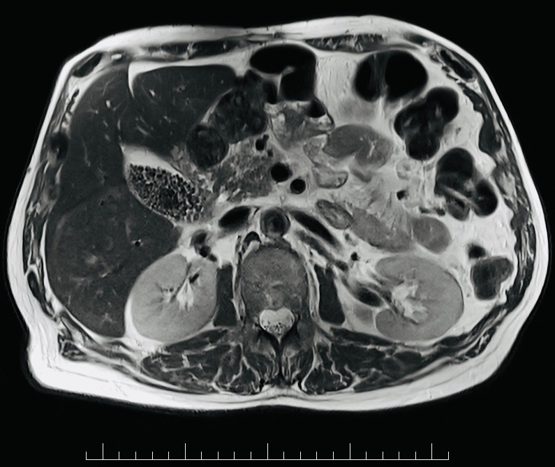 Abdominal MRI example used to illustrate staging imaging